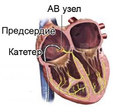 Читать статью полностью Что такое деструкция атриовентрикулярного соединения