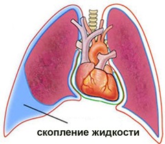 Читать статью полностью Что такое гидроторакс?