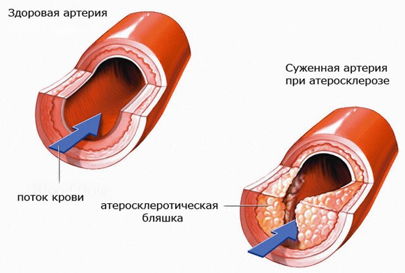 Читать статью полностью Что такое атеросклеротическая бляшка и почему она развивается?