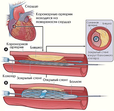 Что собой представляет стентирование?