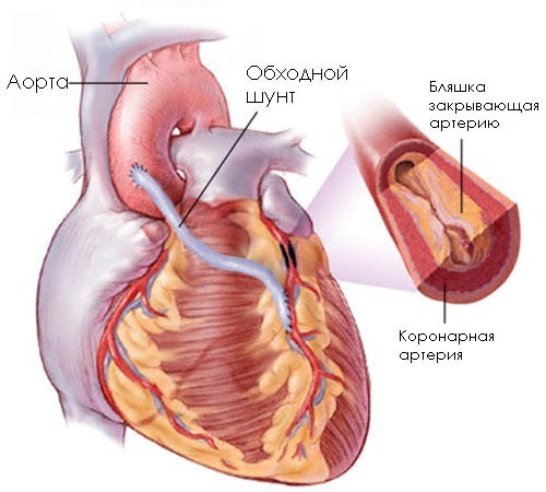 АКШ – Аортокоронарное шунтирование сердца