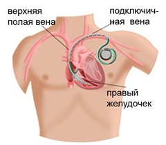 Читать статью полностью Лечение атриовентрикулярной блокады