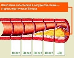 Читать статью полностью Что такое атеросклероз?