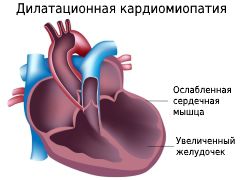 Что происходит с сердцем при дилатационной кардиомиопатии