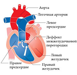 Читать статью полностью Тетрада Фалло