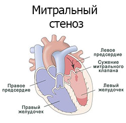 Читать статью полностью Митральный стеноз
