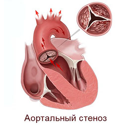 Читать статью полностью Аортальный стеноз