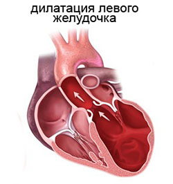 Читать статью полностью Дилатация левого желудочка