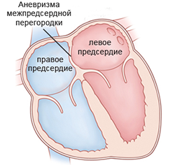 Читать статью полностью Аневризма межпредсердной перегородки (МПП)