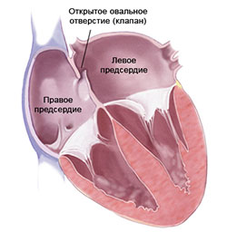 Читать статью полностью Что такое открытое овальное окно (ООО)