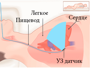 Читать статью полностью Чреспищеводная эхокардиография