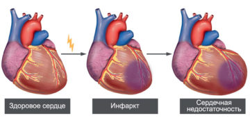 Что происходит с сердцем при инфаркте?