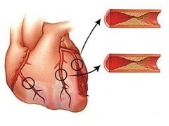 Непроникающий, Q-негативный инфаркт миокарда, или инфаркт миокарда без элевации ST