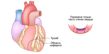 Непроникающий, Q-негативный инфаркт миокарда, или инфаркт миокарда без элевации ST