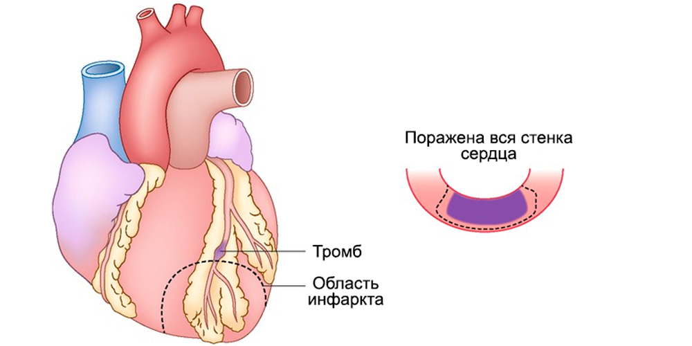 Проникающий, трансмуральный, Q-позитивный инфаркт миокарда, или инфаркт миокарда с элевацией ST