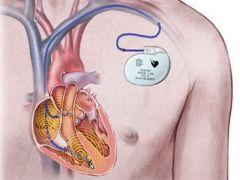 Что такое кардиостимулятор и как он устанавливается
