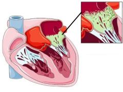 Что происходит с сердцем при развитии бактериального эндокардита