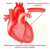 Что такое ишемическая болезнь сердца - ИБС
