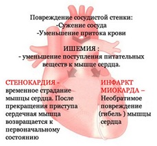 Ишемия, стенокардия, инфаркт