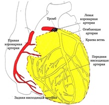 Передний инфаркт миокарда