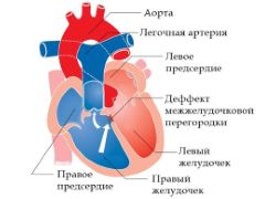 Как работает сердце при тетраде Фалло