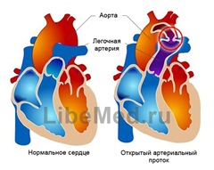Как распознать открытый артериальный проток