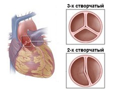 Противопоказания при двустворчатом аортальном клапан